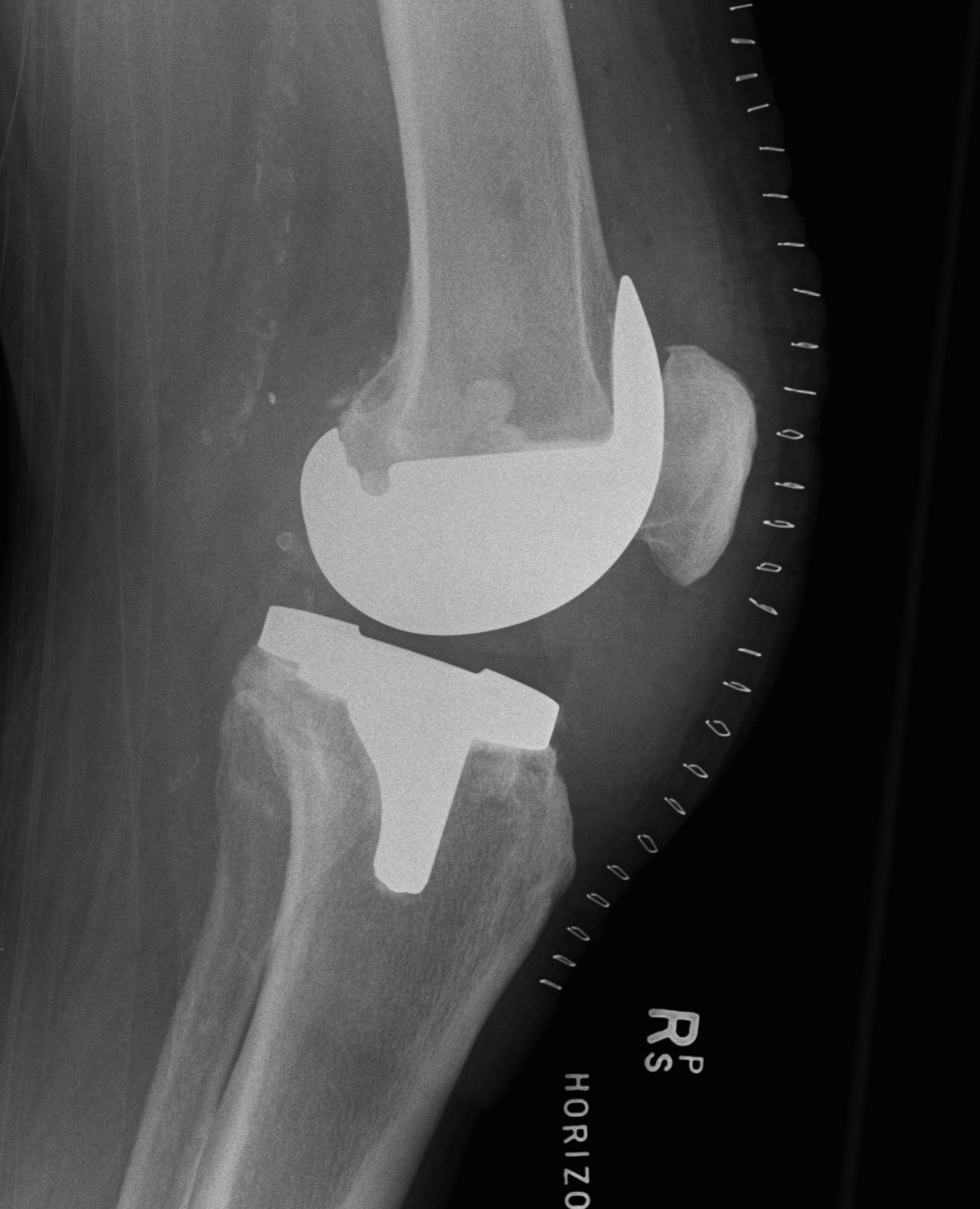 TKR Posterior Stabilised